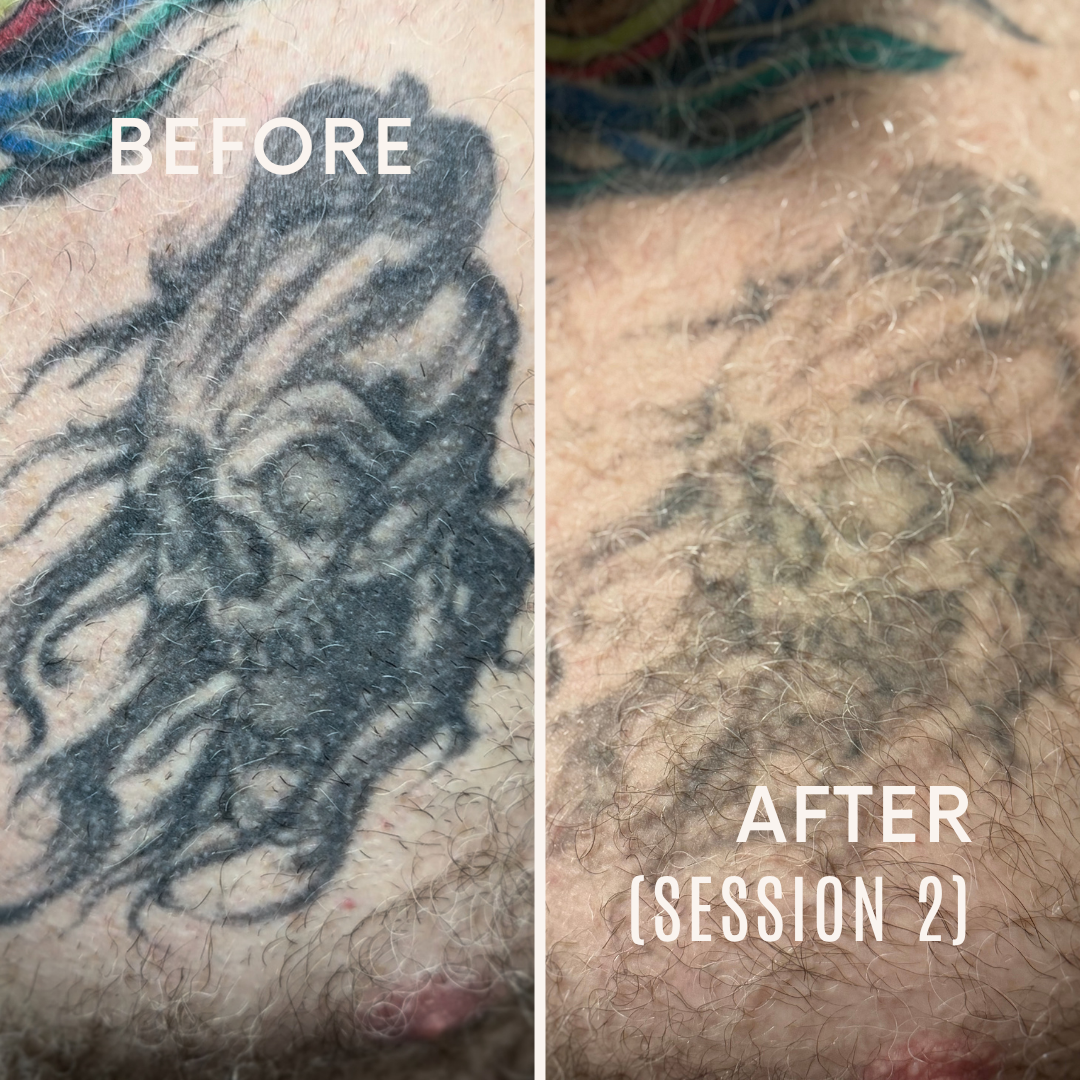 Before+after+tattoo+removal+Instagram+post