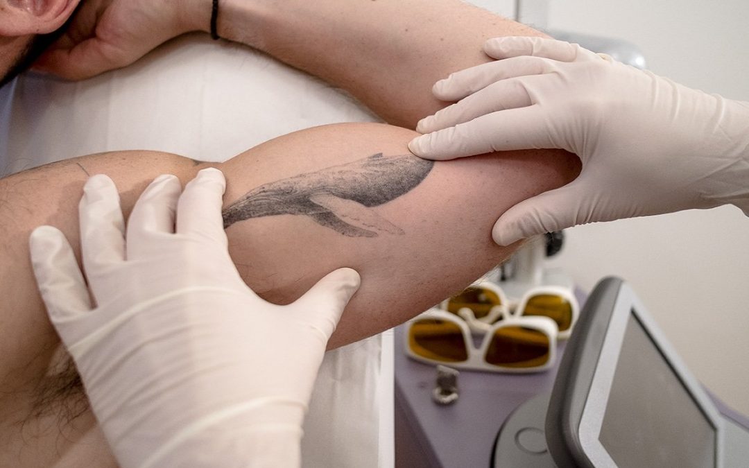 Tattoo Removal Service CDA Idaho