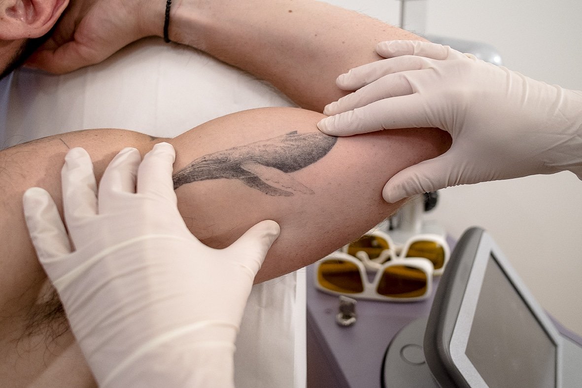 Tattoo Removal Service CDA Idaho