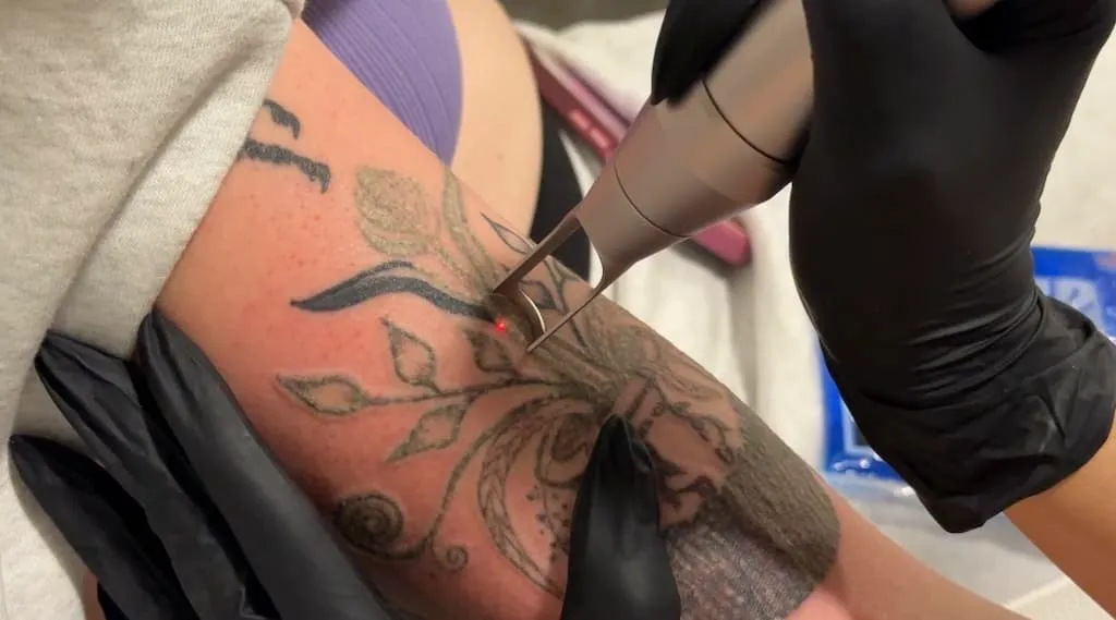 Tattoo Removal Service Coeur D’Alene Idaho 16