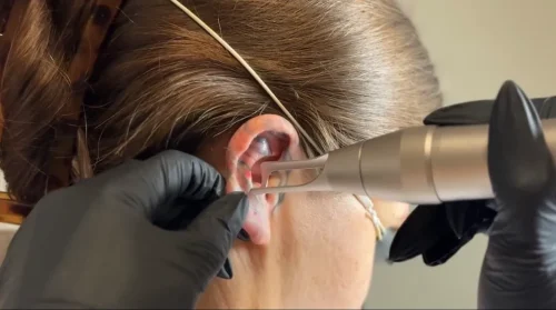 Tattoo Removal Service Coeur D’Alene Idaho 13