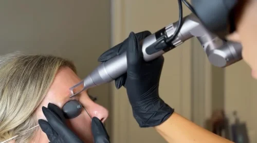Tattoo Removal Service Coeur D’Alene Idaho 14