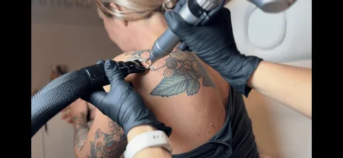 Tattoo Removal Service Coeur D’Alene Idaho 18