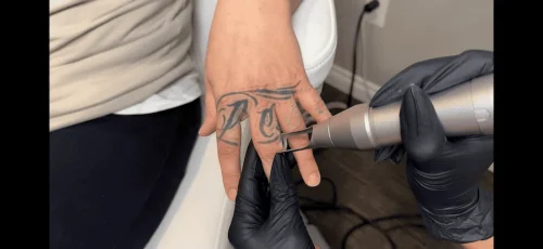 Tattoo Removal Service Coeur D’Alene Idaho 19