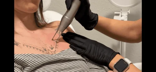 Tattoo Removal Service Coeur D’Alene Idaho 20