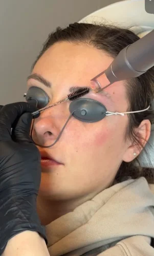 Tattoo Removal Service Coeur D’Alene Idaho 21