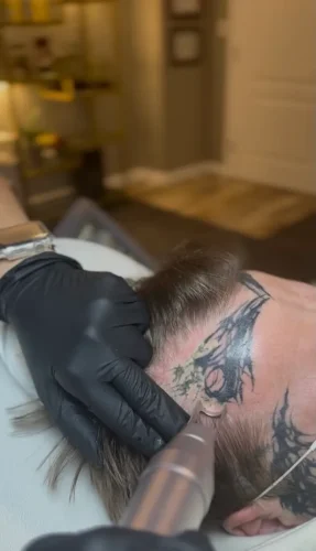 Tattoo Removal Service Coeur D’Alene Idaho 8