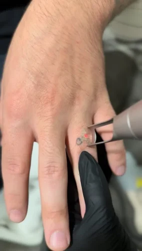 Tattoo Removal Service Coeur D’Alene Idaho 9