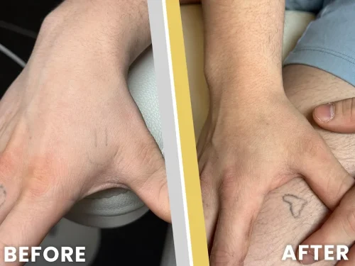 Tattoo Removal Service Coeur D’Alene Idaho Before And After 3