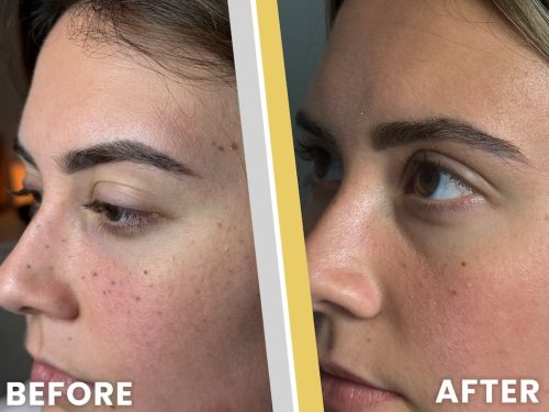 Tattoo Removal Service Coeur D’alene Idaho Before And After 4