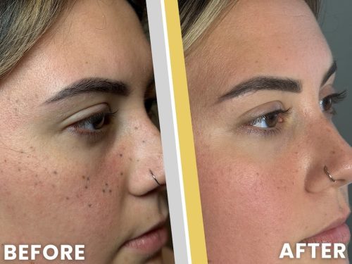 Tattoo Removal Service Coeur D’alene Idaho Before And After 5