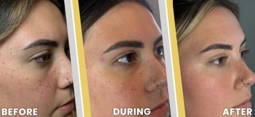 Tattoo Removal Service Coeur D’alene Idaho Before And After 6