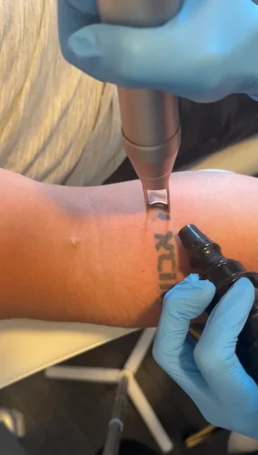 5-tulsa-tattoo-removal-service-IMG 20260804 092847
