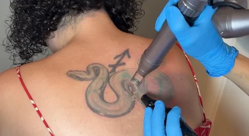 7-tulsa-tattoo-removal-service-IMG 20260804 092851
