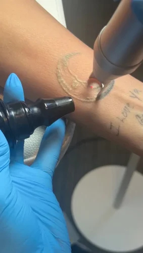 9-tulsa-tattoo-removal-service-IMG 20260804 092901