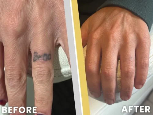 Tattoo-Removal-Service-Coeur-dAlene-Idaho-Before-and-After-1
